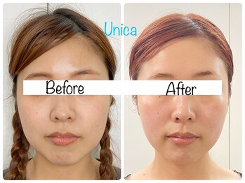 ウニカ(Unica)/BeforeAfter