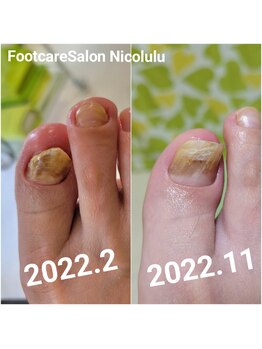 ニコルル 高崎パルクハナミズキ店(Nicolulu)/伸びない爪