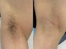 オアシス 相模大野店(Oasis)/【メンズ脱毛】毛のない肌に◎