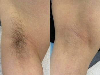 オアシス 相模大野店(Oasis)/【メンズ脱毛】毛のない肌に◎