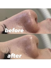 ヴィディトゥ(vidyto)/ENVIRON【黒ずみ毛穴】