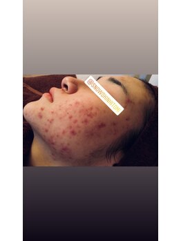 スノースキン(Snow skin)/繰り返す肌荒れには、、