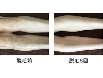 ウル(Ulu)/【足、ヒゲ脱毛！】