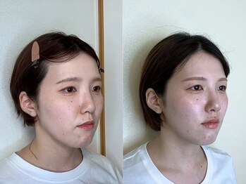 ナビレラ(navillera)/面長・たるみ・筋肉皺