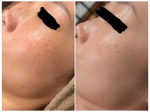 ツーアップ(2up)/肌サロンを超えるフェイシャル