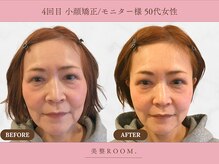 美整ルーム 横浜店(美整ROOM)/4回目施術
