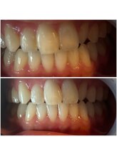エクシアホワイトニング 代々木店/ホワイトニングビフォーアフター