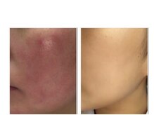 サロンシャイン(Salon Shine)/REVI陶肌トリートメント