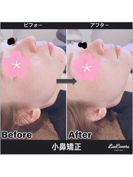 美容矯正サロン レレポノ(LELEPONO)/小鼻矯正ビフォーアフター
