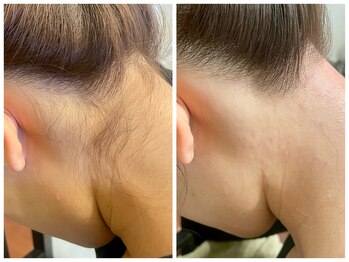 トリディア/えりあし脱毛