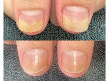 自爪育成〈最強ケア〉10年治らず悩み続けた爪が美しくなりました