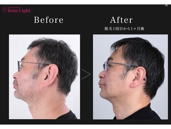 ホルバール 佐賀店(Hallbar)/髭脱毛