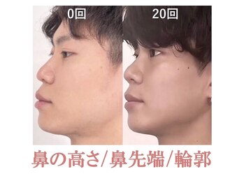 隆鼻矯正専門店 ラプリ(Raplit)/隆鼻＋輪郭矯正40分20回