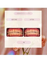 プラスビーセルフ(+b self)/ホワイトニングビフォーアフター