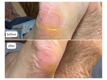 カシェット(Cachette)/60代女性◎足裏角質ケア90分