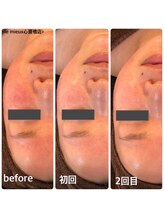 ル ミュー(le mieux)/REVI陶肌トリートメント