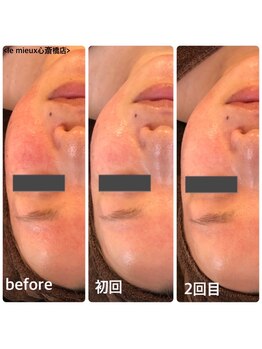 ル ミュー(le mieux)/REVI陶肌トリートメント