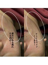 ミヨン(Miyong)/重みのある頬のお肉改善♪