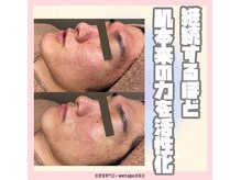 ホワイトアクア 岐阜店(WHITE AQUA)/ハーブピーリング/岐阜/毛穴