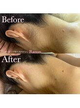 ラナン(Ranun)/角質・毛穴汚れも取れる脱毛法