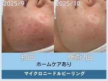 アロマ(AROMA)/赤ニキビケア/毛穴/越谷