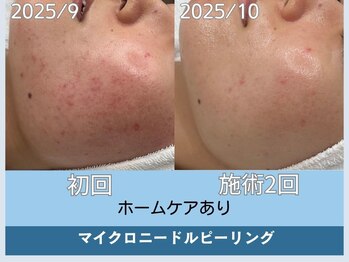 アロマ(AROMA)/赤ニキビケア/毛穴/越谷