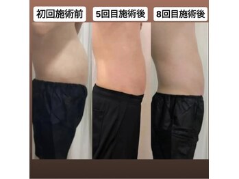 クレール 小山店(CLAIR)/【痩身(3ステップ)】