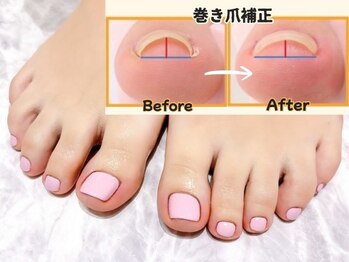 オー 町田モディ店(Oh!)の写真/【フットネイル専門店】巻き爪、足の深爪などのお悩みもお任せ！フットケア&カラーで足元から魅力的に！