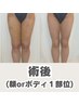 【術後/ボディ1部位or顔】ダウンタイム改善、回復促進、仕上がりサポート70分
