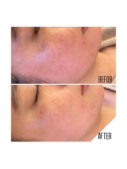 アクアンフィニィ(aquanfini)/敏感すぎるお肌はこちらを