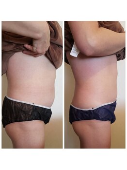 ロージーハピネス(Rosy happiness)/40代からの気になるお腹