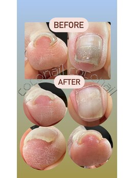 ココネイル(coconail)/巻き爪矯正