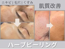 ソワンボーテ(Soin Beaute)の雰囲気(肌質改善ならハーブピーリング)