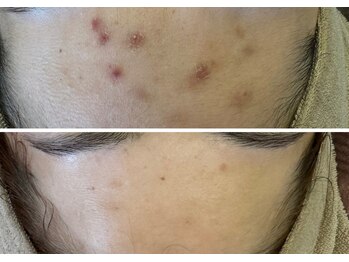 ベル(Belle)/ハイドロ/ニキビケアにも最適！