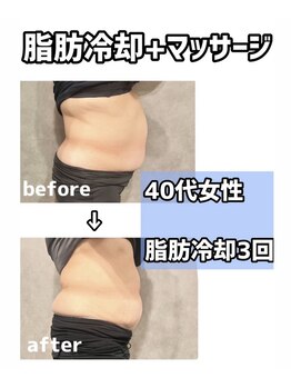 シャルム(CHARME)/脂肪冷却