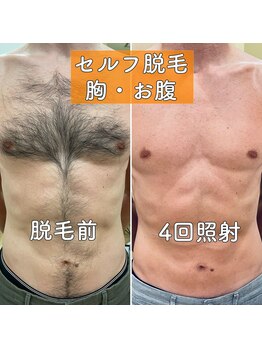 みつばちさろん/【セルフ脱毛】施術例「胸・腹」