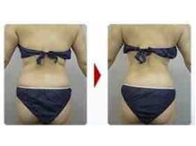 ブランシェ 富山店 × 椿/筋膜セラピー効果