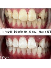 ホワイト 福岡博多店(WHITE)/ホワイトニングビフォーアフター