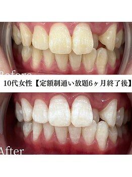 ホワイト 福岡博多店(WHITE)/ホワイトニングビフォーアフター