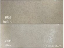 サロン ド ブラン アオヤマ(Salon de BLANC AOYAMA)/背中ハーブピーリング