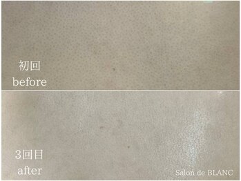 サロン ド ブラン アオヤマ(Salon de BLANC AOYAMA)/背中ハーブピーリング