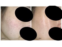 ベッラ(BELLA)の雰囲気(300種類の酵素の力で肌トラブルを改善◎)