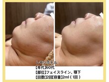 リファイン(REFINE)/レモンボトル原液導入★薄めなし