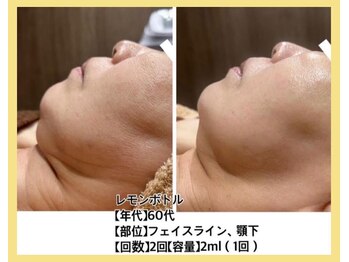 リファイン(REFINE)/レモンボトル原液導入★薄めなし