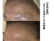 ボニータ(Bonita)/【Lit】ヒト臍帯幹細胞エステ