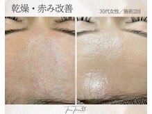 スリースリー 恵比寿(THREE THREE)/乾燥・赤みケア