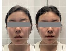 クレファ(CREFA)の雰囲気（即実感×持続力 たった1回で小顔実感！ほうれい線、シワにも◎）
