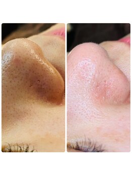 アルテ ベップ(arte BEPPU)/毛穴ケア/イチゴ鼻もごっっそり