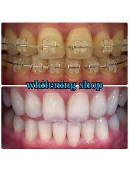 ホワイトニングショップ 福島店(WHITENINGSHOP)/アタッチメント付きでもOK！