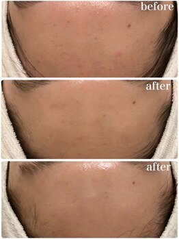 リリィブラン(Lily branc)/毛穴ニキビケア/ピーリング